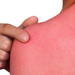 Fastest-Way-to-Relieve-a-Sunburn